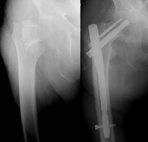 Figure-7-a-Fracture-Pertrochanterienne-b-Osteosynthese-par-un-Clou